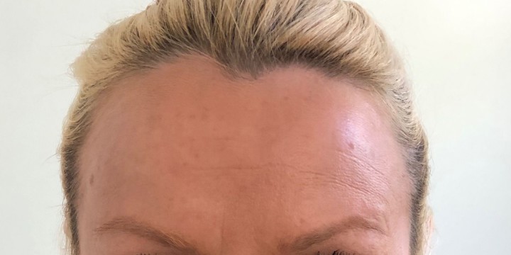 After treatment, same Glowday case 3