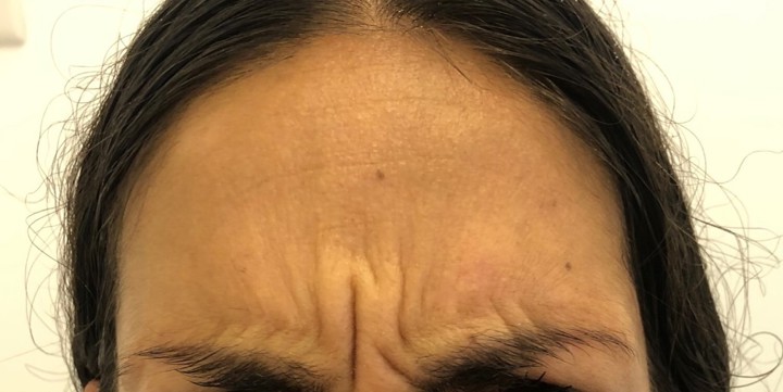 Before treatment, Glowday case 4