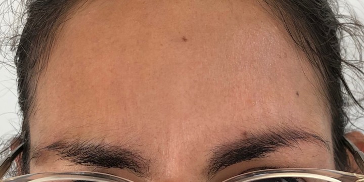After treatment, same Glowday case 4