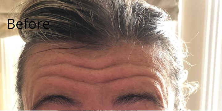 Before treatment, Glowday case 1