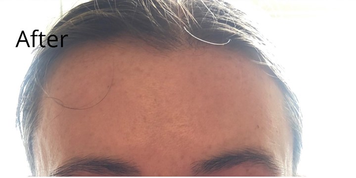 After treatment, same Glowday case 1