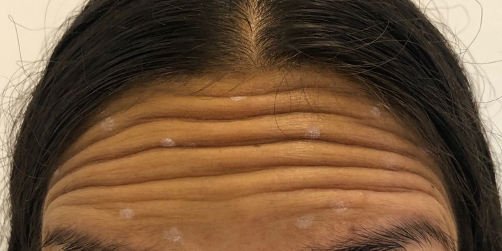 Before treatment, Glowday case 2