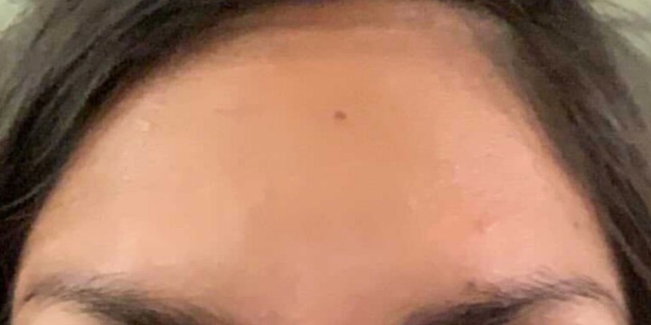 After treatment, same Glowday case 2
