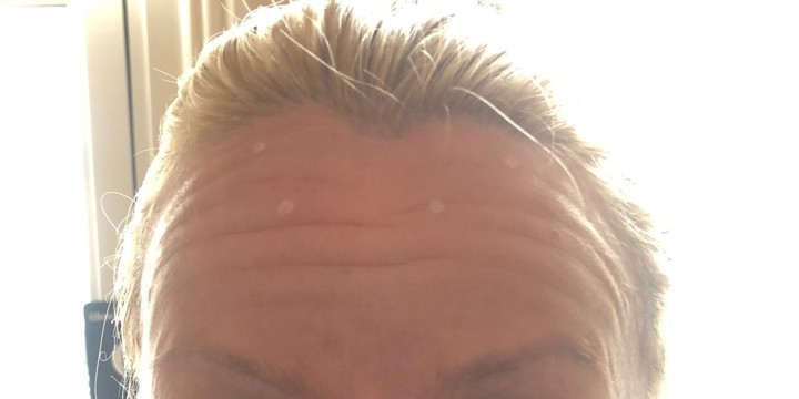 Before treatment, Glowday case 3